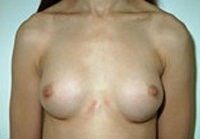 Breast Augmentation: After Treatment Photos - female, front view, patient 4