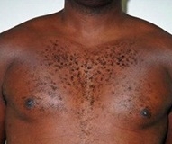 Gynecomastia. After Treatment Photos - male, front view, patient 4