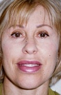 Facelift - After Treatment Photos - female, front view, patient 5