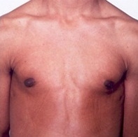 Gynecomastia. After Treatment Photos - male, front view, patient 5