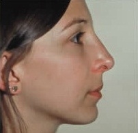 Rhinoplasty. After Treatment Photos - female, right side view, patient 6