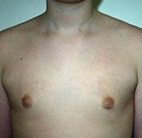 Gynecomastia. After Treatment Photos - male, front view, patient 6
