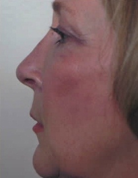Rhinoplasty. After Treatment Photos - female, left side view, patient 7