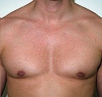 Gynecomastia. After Treatment Photos - male, front view, patient 7