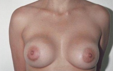 Breast Augmentation: After Treatment Photos - female, front view, patient 7