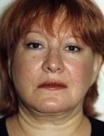 Facelift - After Treatment Photos - female, front view, patient 8