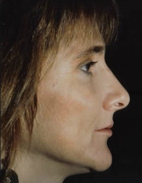Rhinoplasty. After Treatment Photos - female, right side view, patient 8