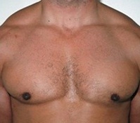 Gynecomastia. After Treatment Photos - male, front view, patient 8