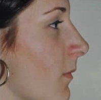 Rhinoplasty. After Treatment Photos - female, right side view, patient 9