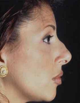 Rhinoplasty. Before Treatment Photos - female, right side view, patient 10