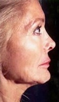 Facelift - Before Treatment Photos - female, right side view, patient 1