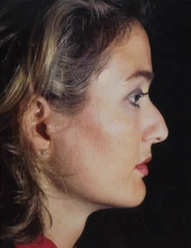 Rhinoplasty. Before Treatment Photos - female, right side view, patient 11