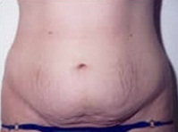 Tummy Tuck - Before Treatment Photos - female, front view, patient 1