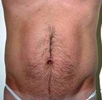Torsoplasty. Before Treatment Photos - male, front view, patient 1