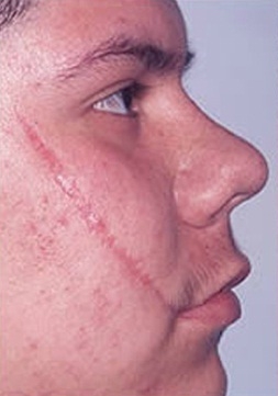 Skin Treatments - Before Treatment Photos - female, right side view, patient 1 (face)