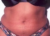 Liposuction Abdomen - Before Treatment Photos - female, front view, patient 1