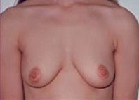 Breast Augmentation: Before Treatment Photo - female, front view, patient 1