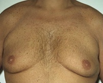 Gynecomastia. Before Treatment Photos - male, front view, patient 1