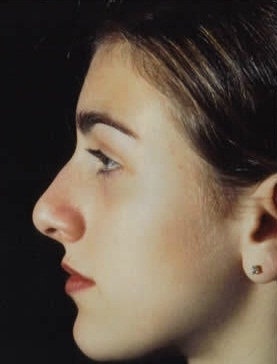 Rhinoplasty. Before Treatment Photos - female, left side view, patient 12