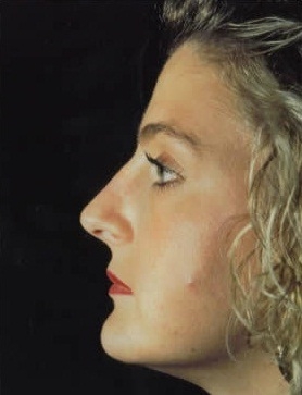 Rhinoplasty. Before Treatment Photos - female, left side view, patient 13