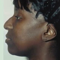 Rhinoplasty. Before Treatment Photos - female, left side view, patient 15