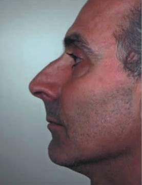 Rhinoplasty. Before Treatment Photos - male, left side view, patient 17