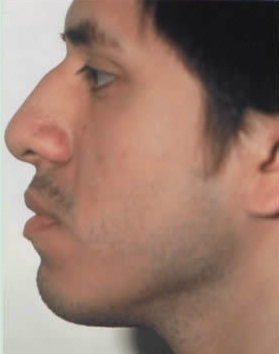 Rhinoplasty. Before Treatment Photos - male, left side view, patient 18