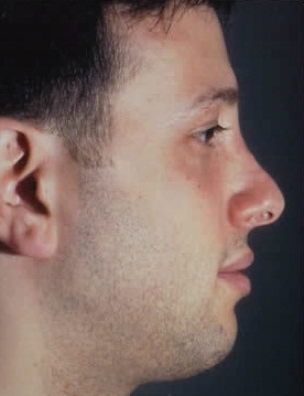 Rhinoplasty. Before Treatment Photos - male, right side view, patient 19