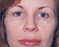 Mid Facelift - Before Treatment Photos - female, front view, patient 2
