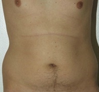 Torsoplasty. Before Treatment Photos - male, front view, patient 2
