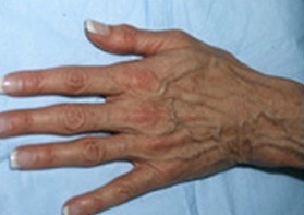 Skin Treatments - Before Treatment Photos - female, top view, patient 2 (hands)