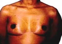 Breast Augmentation: Before Treatment Photos - female, front view, patient 2