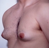 Gynecomastia. Before Treatment Photos - male, oblique view, patient 2