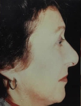 Rhinoplasty. Before Treatment Photos - female, right side view, patient 2