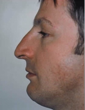 Rhinoplasty. Before Treatment Photos - male, left side view, patient 22