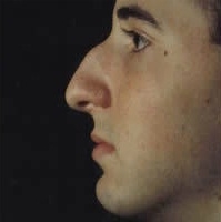 Rhinoplasty. Before Treatment Photos - male, left side view, patient 24
