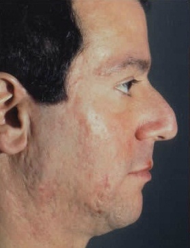 Rhinoplasty. Before Treatment Photos - male, right side view, patient 25