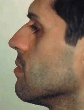 Rhinoplasty. Before Treatment Photos - male, left side view, patient 26