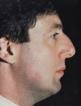 Rhinoplasty. Before Treatment Photos - male, right side view, patient 28