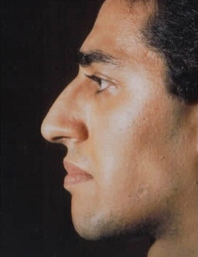 Rhinoplasty. Before Treatment Photos - male, left side view, patient 29