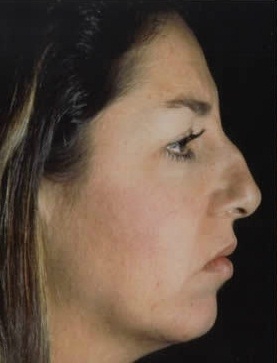 Rhinoplasty. Before Treatment Photos - female, right side view, patient 3