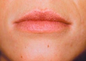 Skin Treatments - Before Treatment Photos - female, front view, patient 3 (lips)