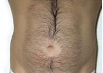 Liposuction Abdomen - Before Treatment Photos - male, front view, patient 3
