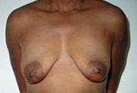 Breast Augmentation: Before Treatment Photos - female, front view, patient 3