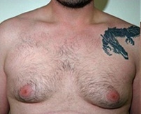 Gynecomastia. Before Treatment Photos - male, front view, patient 3