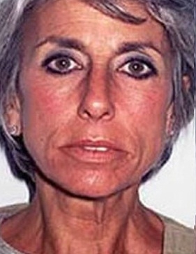 Facelift - Before Treatment Photos - female, front view, patient 4