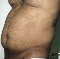 Torsoplasty. Before Treatment Photos - male, left side oblique view, patient 4