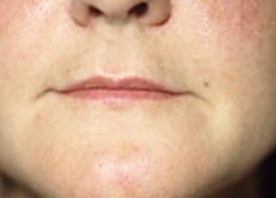 Skin Treatments - Before Treatment Photos - female, front view, patient 4 (lips)