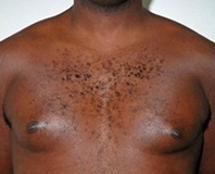 Gynecomastia. Before Treatment Photos - male, front view, patient 4