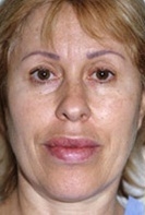 Facelift - Before Treatment Photos - female, front view, patient 5